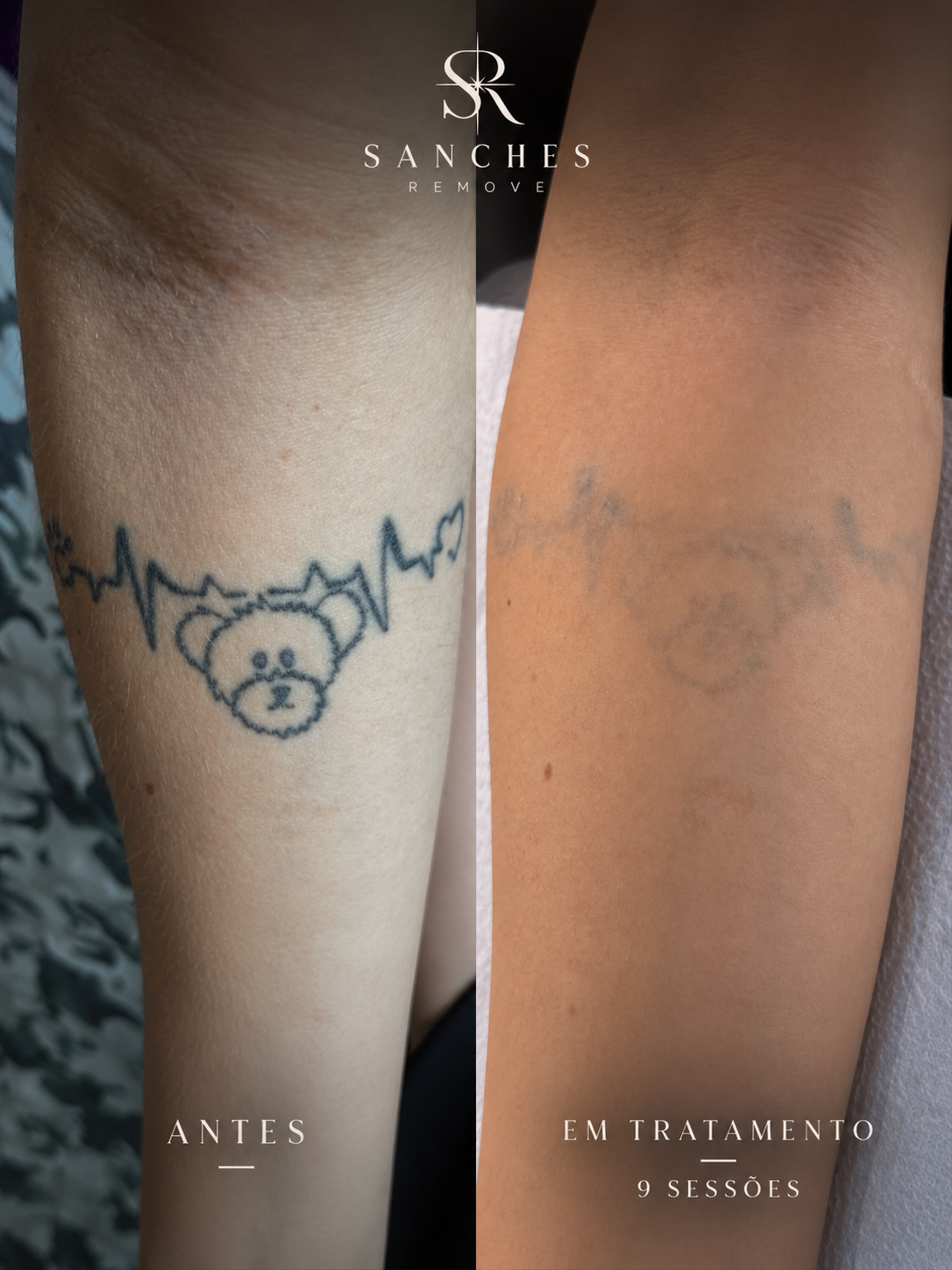 Evolução da remoção de tatuagem após 9 sessões
