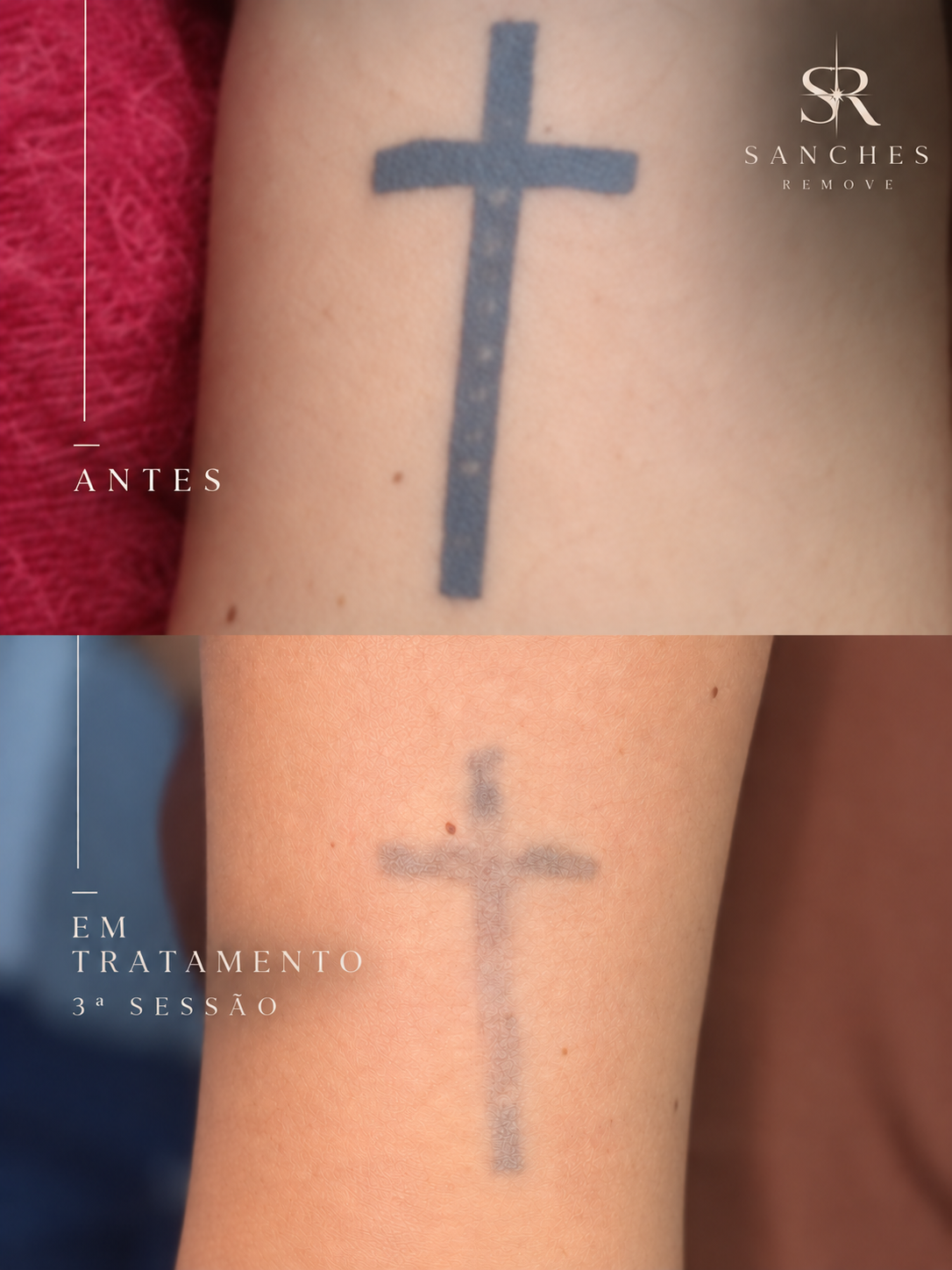 Evolução da remoção de tatuagem após 3 sessões
